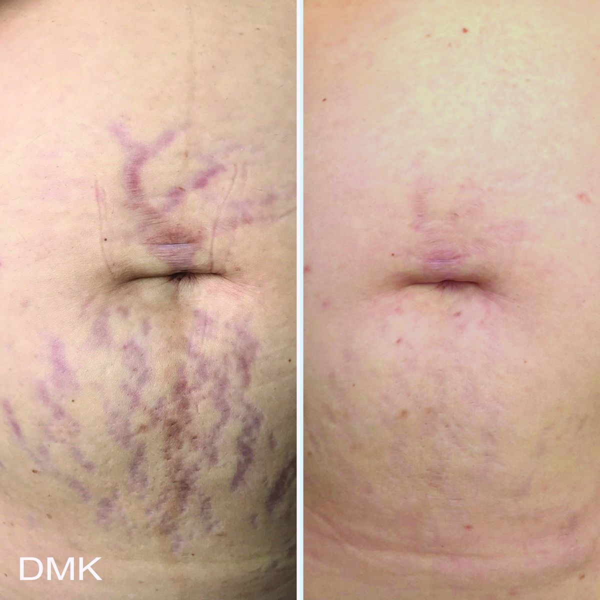 Abdominal stretch marks before and after one enzyme therapy treatment
