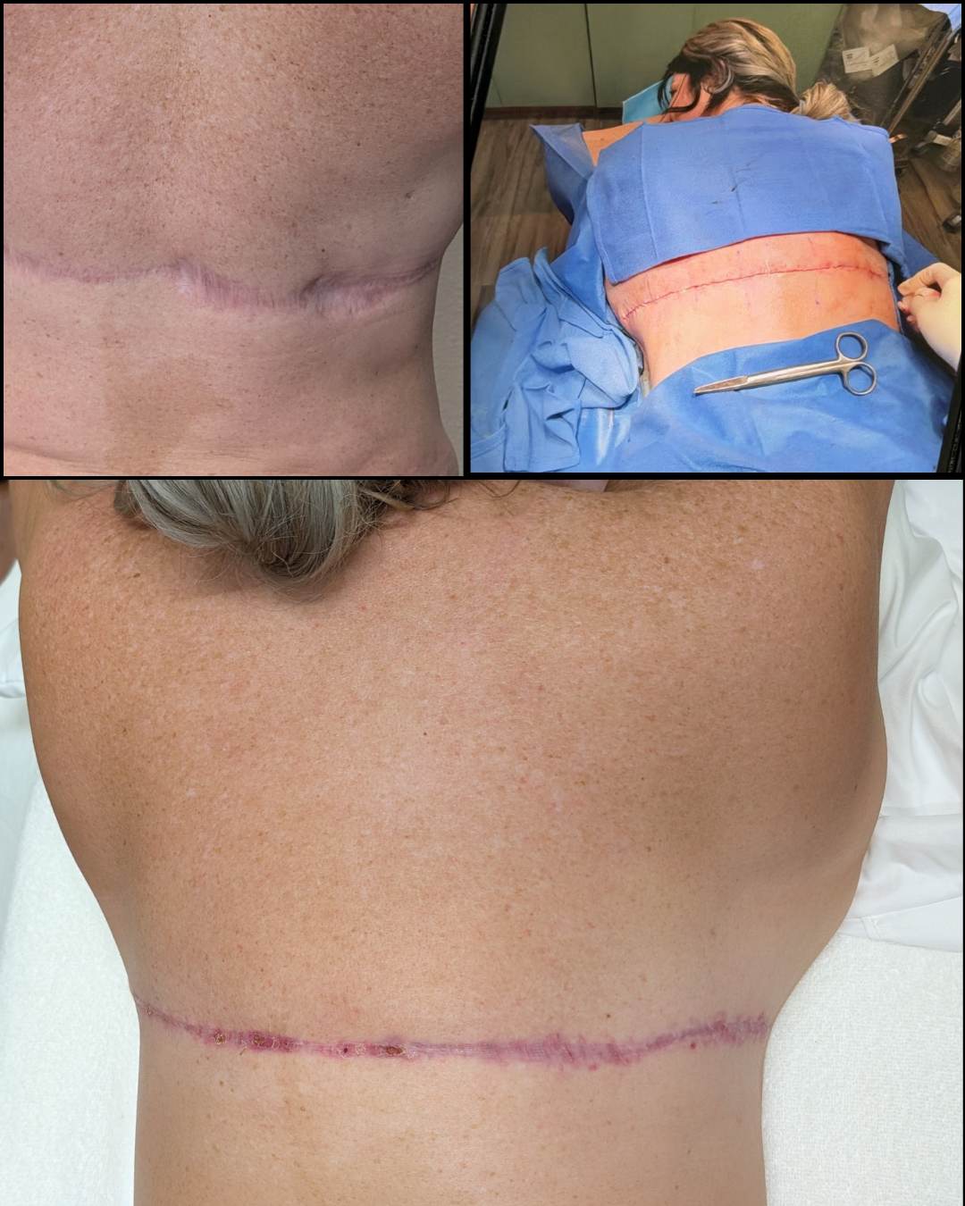 Back scar prepared before a scar revision procedure and conditioned afterward