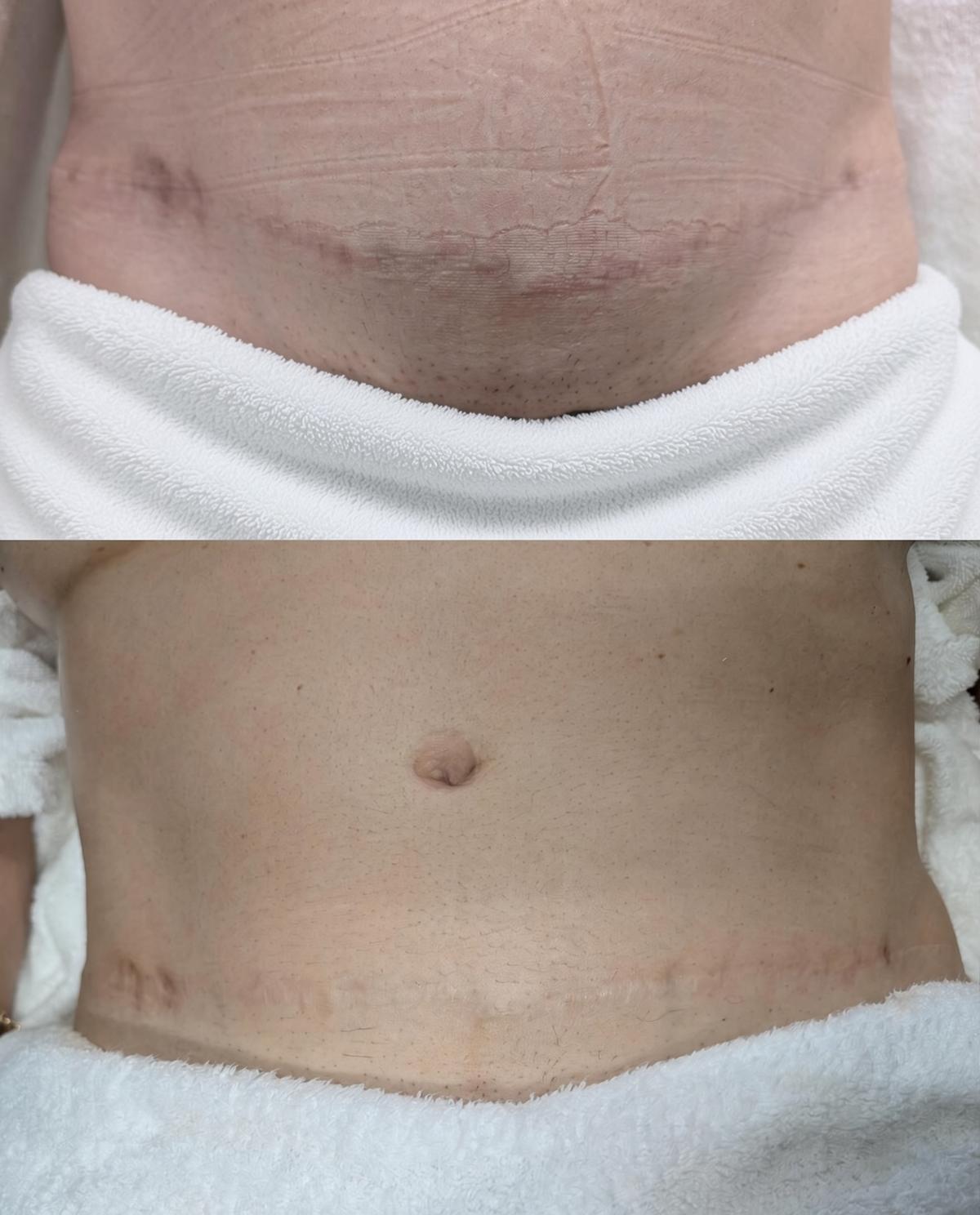 Abdominal surgical scar over five years old, before and after a single treatment