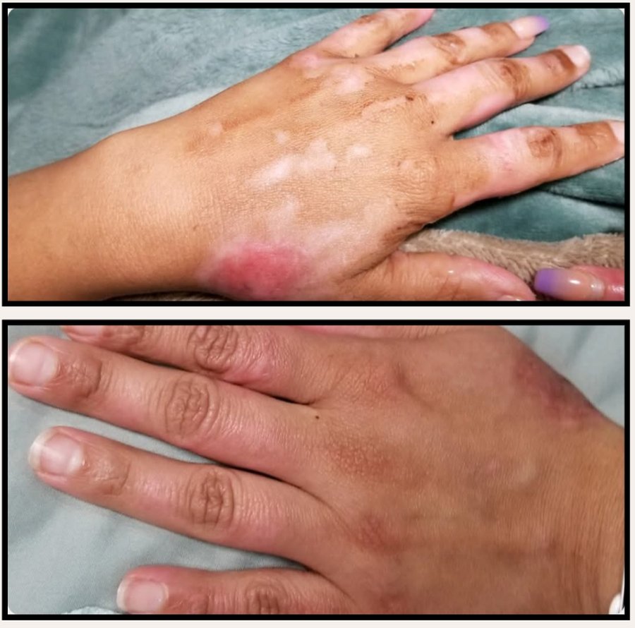 Scar tissue before and after treatment