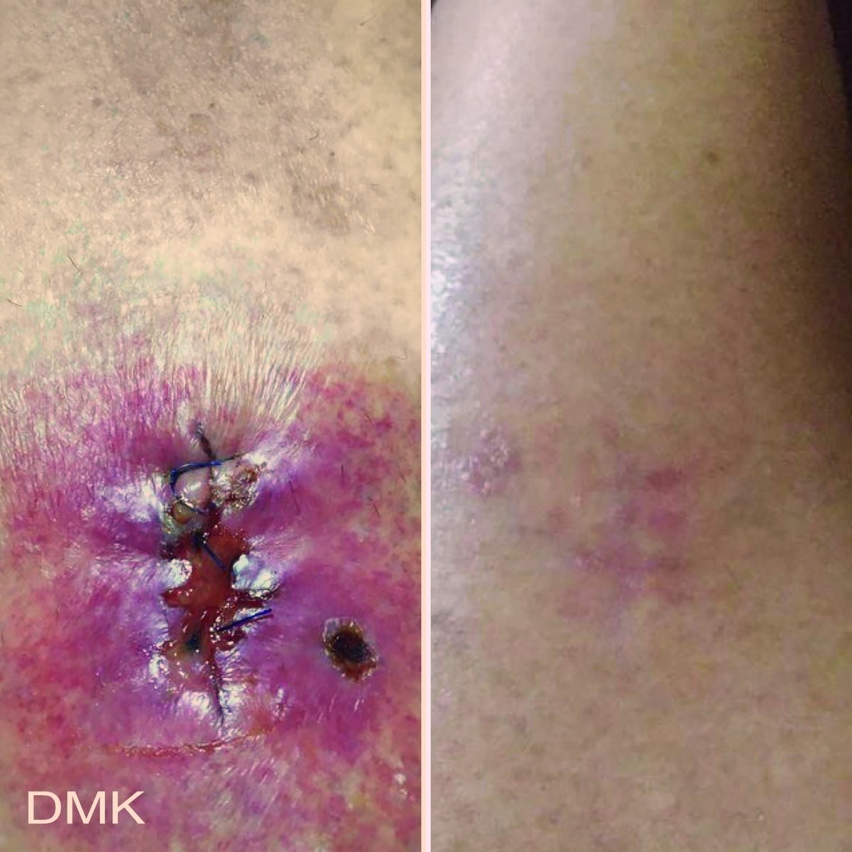 A sutured surgical wound and the same site after healing with enzyme therapy support