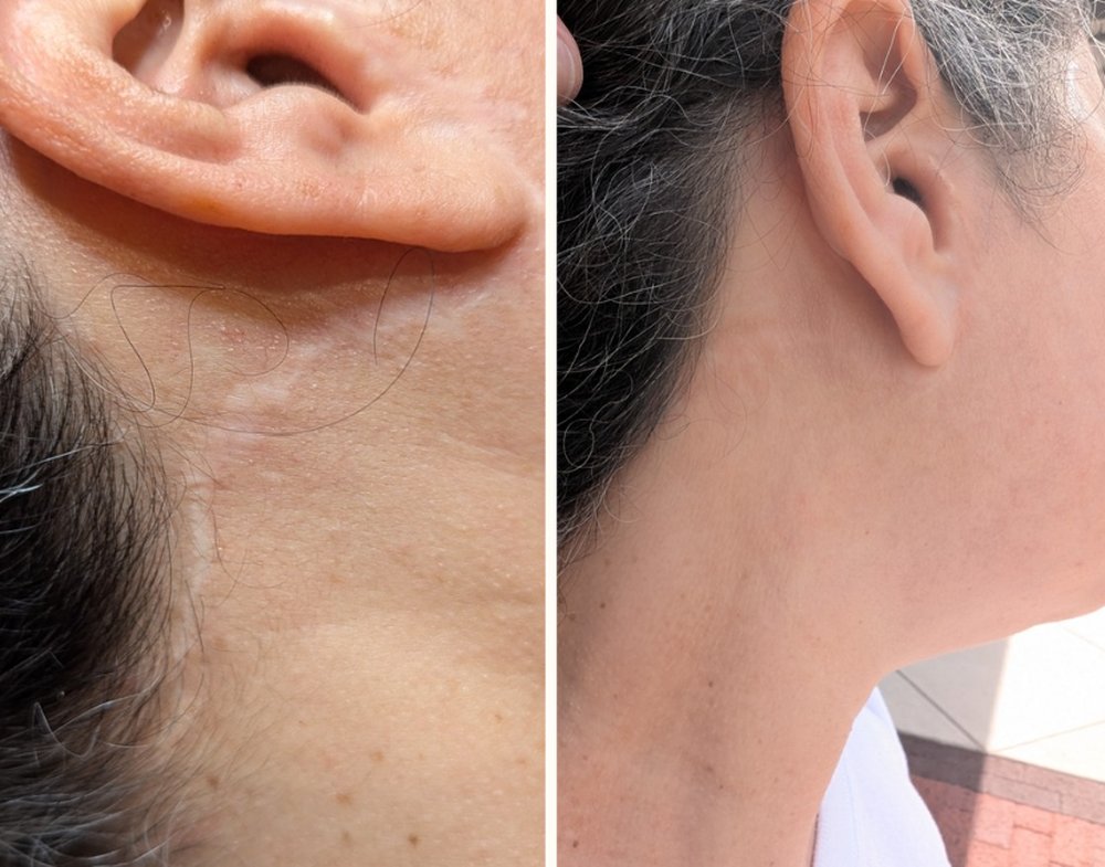 Scar tissue before and after treatment