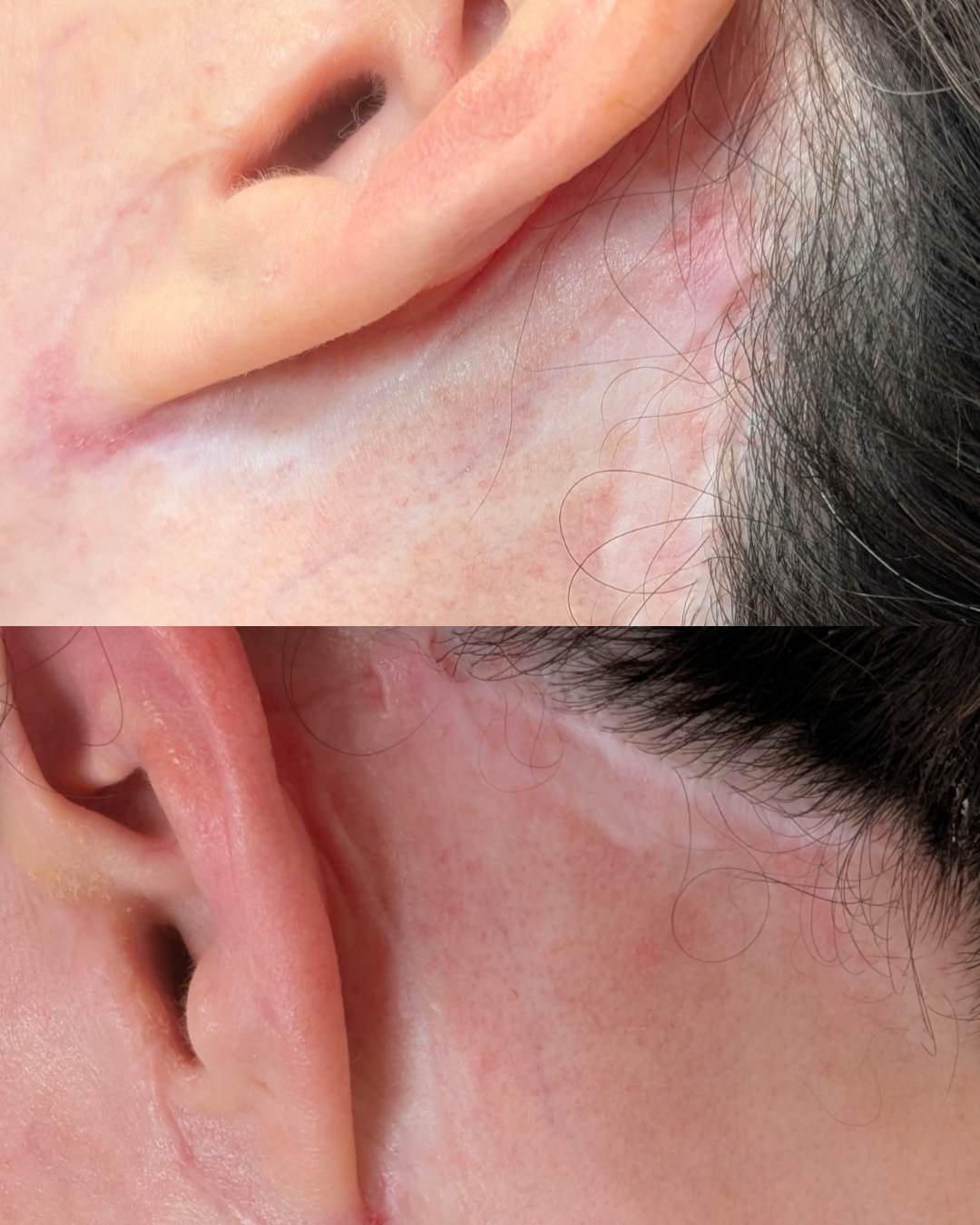 Facial scar over five years old, before and after a single treatment