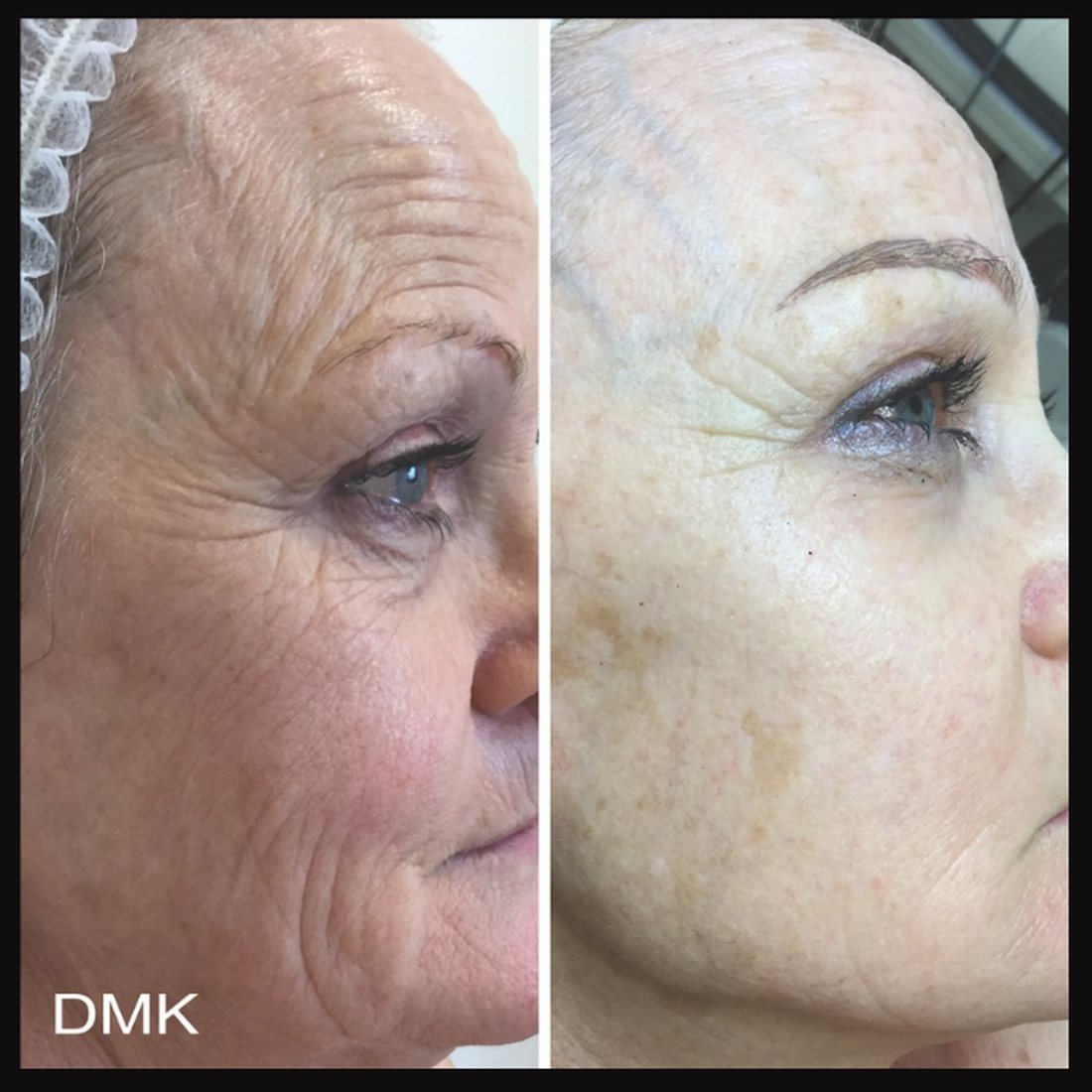 Before and after result