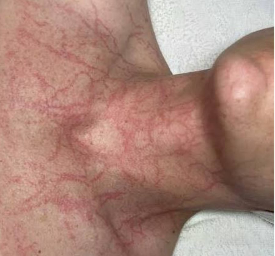 Capillary network visible on the skin after treatment