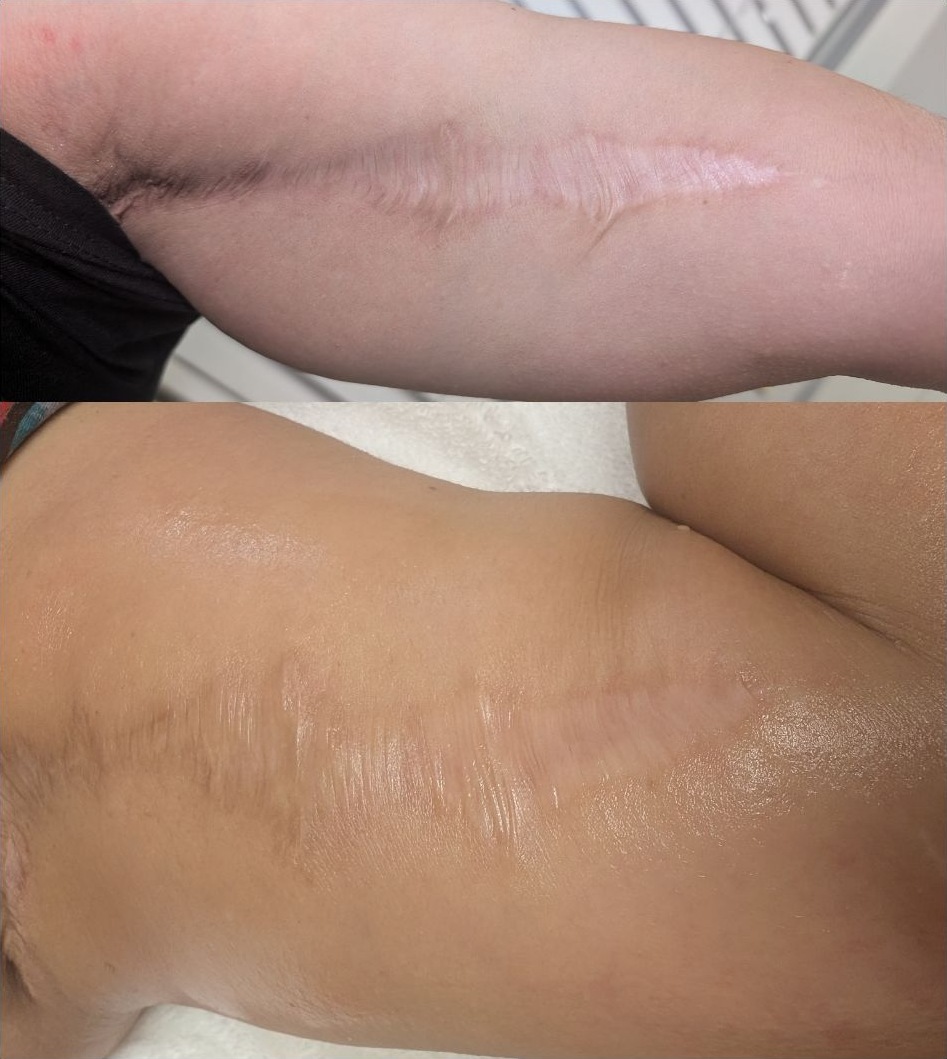 Arm scar six years old, before and after six months of treatment