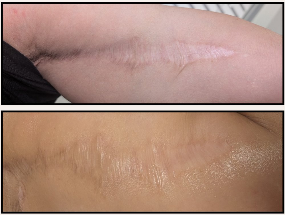 Scar tissue before and after treatment